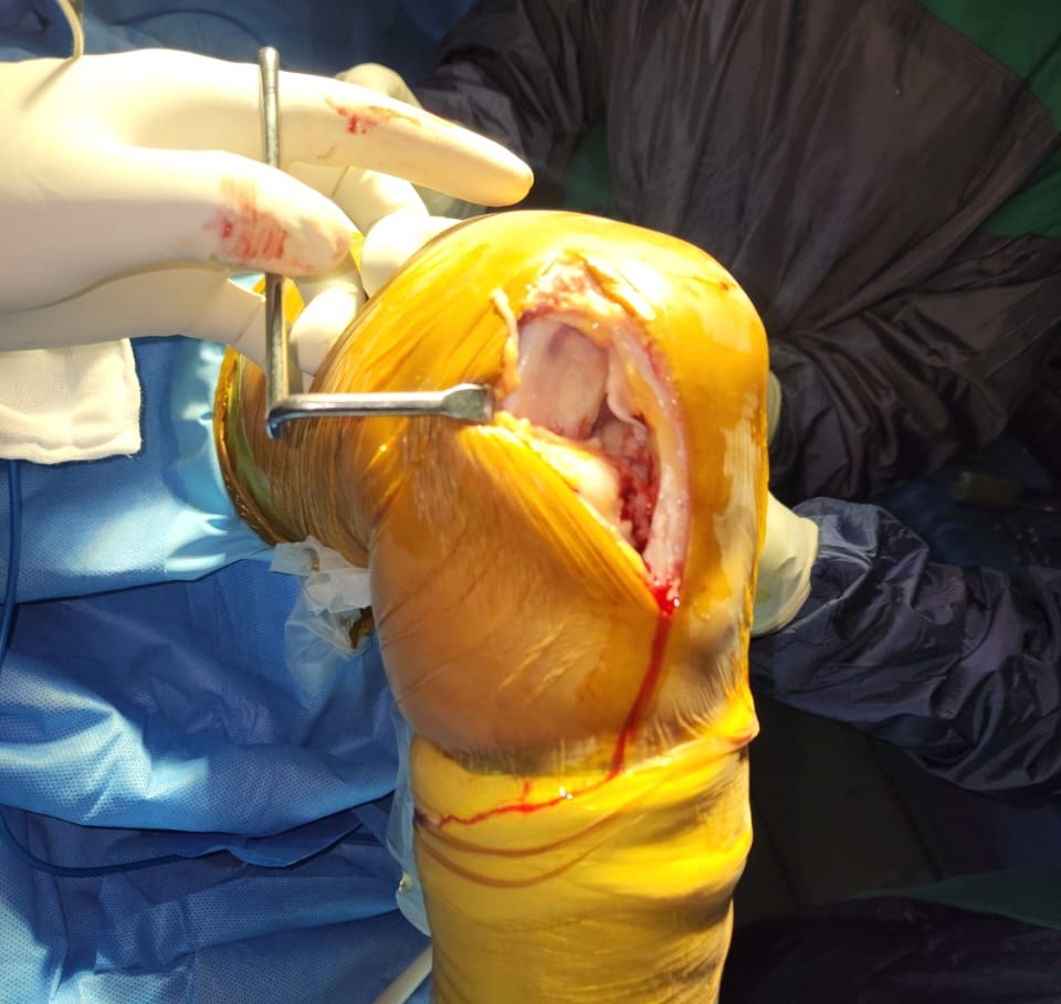 Robotic total Knee Replacement in Mandi HP